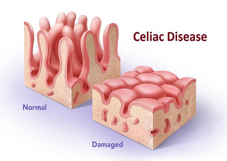 Bệnh celiac