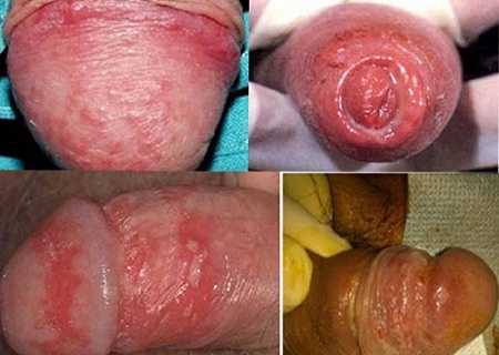 Triệu chứng của bệnh viêm quy đầu