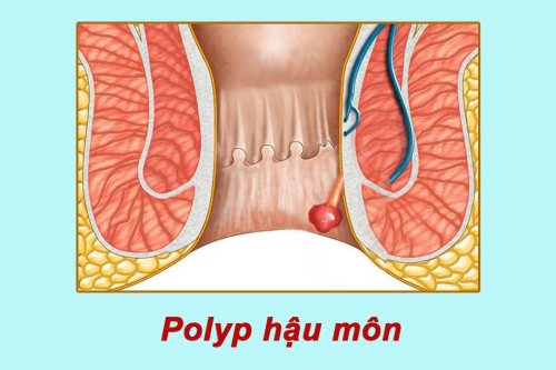 Polyp hậu môn là bệnh gì?