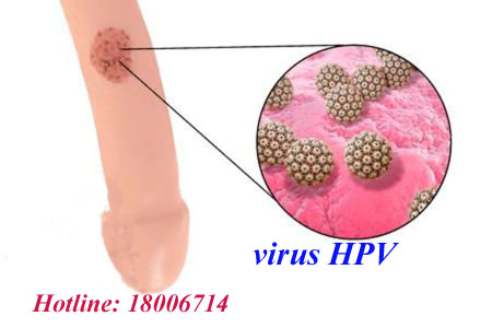 Virus HPV là gì? Chủng virus HPV gây bệnh sùi mào gà bạn nên biết